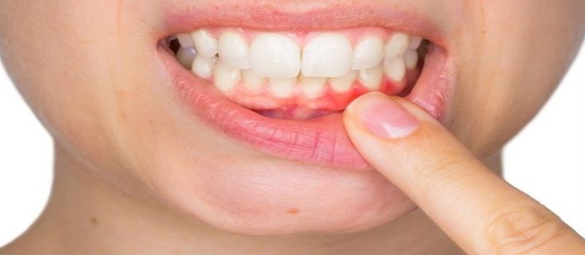Diş Eti Çekilmesi İçin Doğal Tedavi Yöntemleri Nelerdir?