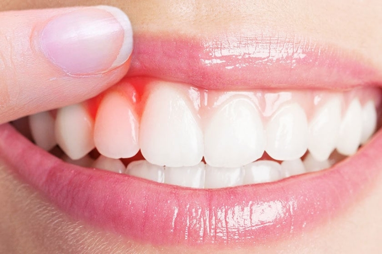 Diş Eti Çekilmesi İçin Doğal Tedavi Yöntemleri Nelerdir?