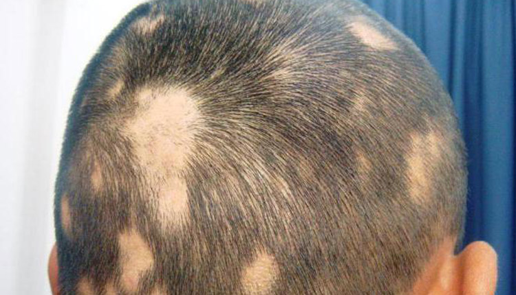 Skarlı Saç Kıran (Alopesi Areata) Nasıl Tedavi Edilir?