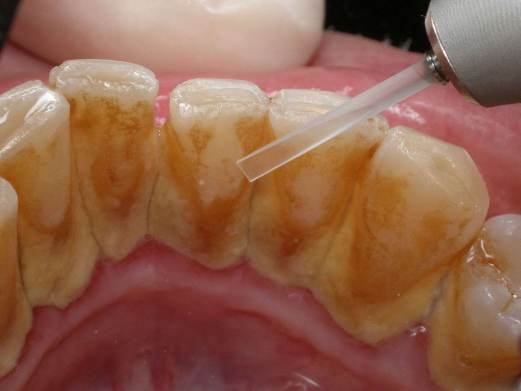 Diş Taşı Neden Olur? Nasıl Yemizlenir?